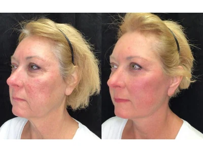 Before and after facelift, patient case 20008, view 4