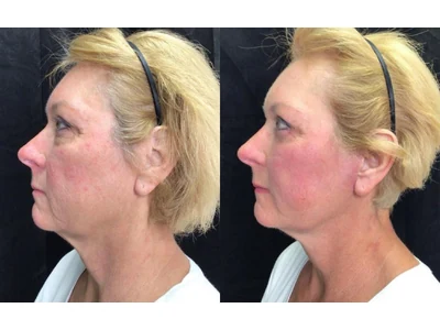 Before and after facelift, patient case 20008, view 5