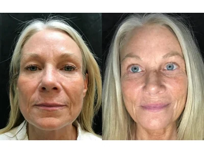 Before and after blepharoplasty, upper and lower lids, patient case 20011, view 1