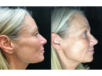 Before and after blepharoplasty, upper and lower lids, patient case 20011, view 2