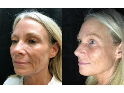 Before and after blepharoplasty, upper and lower lids, patient case 20011, view 3