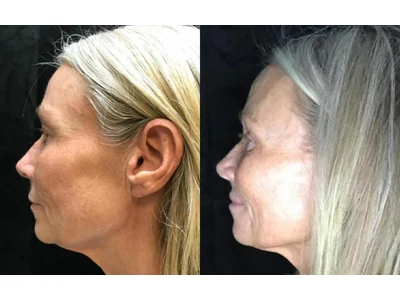 Before and after blepharoplasty, upper and lower lids, patient case 20011, view 4