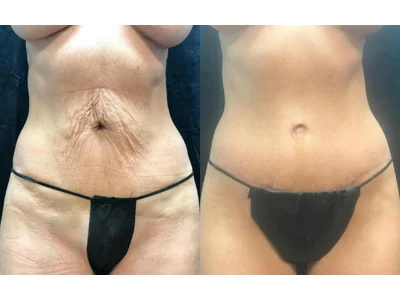 Before and after abdominoplasty, patient case 20012, view 1