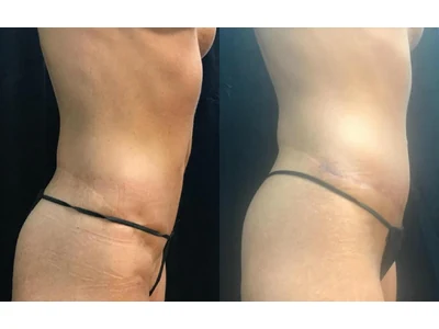 Before and after abdominoplasty, patient case 20012, view 2