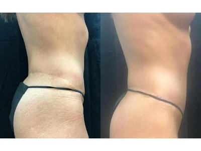 Before and after abdominoplasty, patient case 20012, view 3