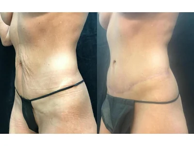 Before and after abdominoplasty, patient case 20012, view 4