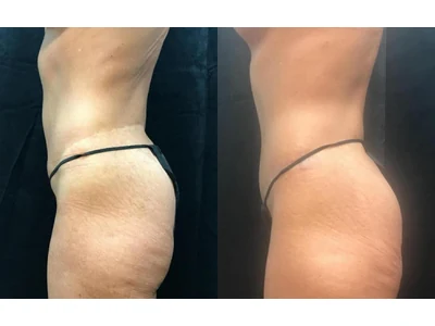 Before and after abdominoplasty, patient case 20012, view 5