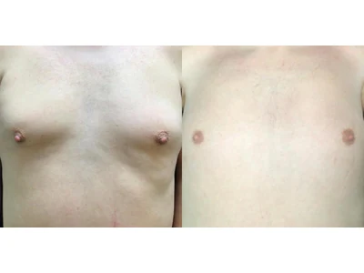 Before and after gynecomastia, patient case 20013, view 1
