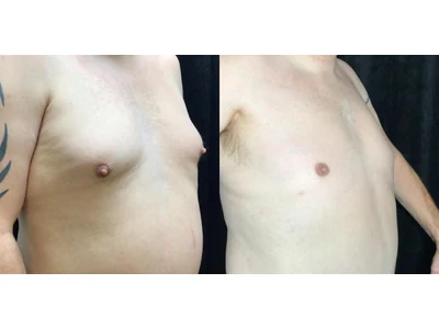 Before and after gynecomastia, patient case 20013, view 2