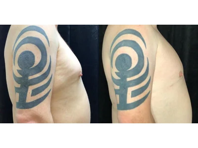 Before and after gynecomastia, patient case 20013, view 3