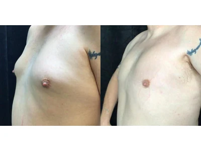 Before and after gynecomastia, patient case 20013, view 4
