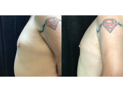 Before and after gynecomastia, patient case 20013, view 5