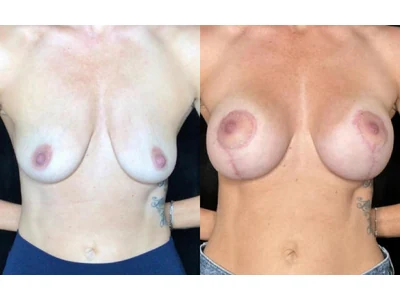 Before and after breast lift, patient case 20014, view 1