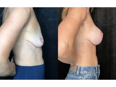 Before and after breast lift, patient case 20014, view 3