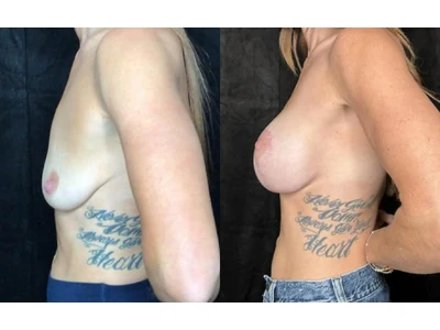 Before and after breast lift, patient case 20014, view 5