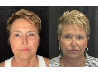 Before and after facelift, patient case 20015, view 1