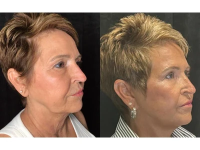 Before and after facelift, patient case 20015, view 2