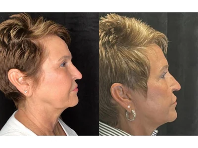 Before and after facelift, patient case 20015, view 3