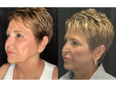 Before and after facelift, patient case 20015, view 4