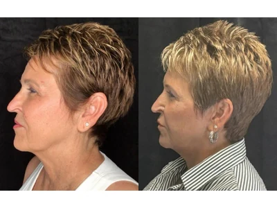 Before and after facelift, patient case 20015, view 5