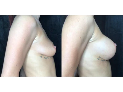 Before and after breast augmentation, patient case 20016, view 3