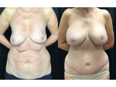 Before and after mommy makeover, patient case 20017, view 1