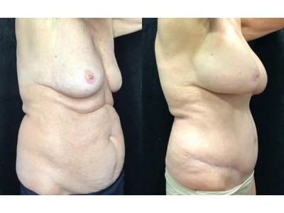 Before and after mommy makeover, patient case 20017, view 2