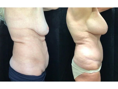 Before and after mommy makeover, patient case 20017, view 3
