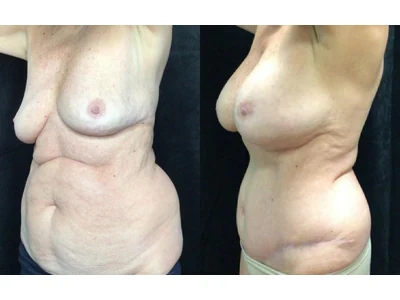 Before and after mommy makeover, patient case 20017, view 4