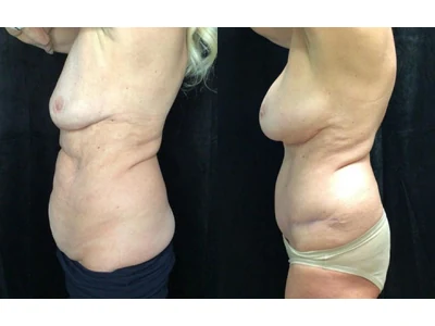 Before and after mommy makeover, patient case 20017, view 5