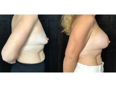 Before and after breast augmentation, patient case 20018, view 3