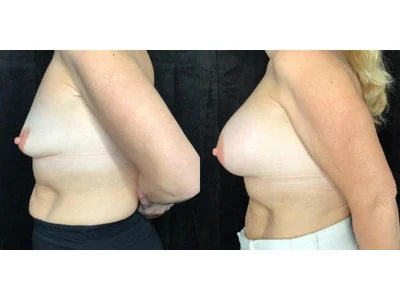 Before and after breast augmentation, patient case 20018, view 5