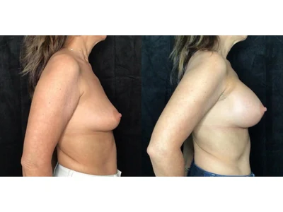 Before and after breast augmentation, patient case 20020, view 3