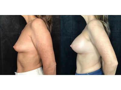 Before and after breast augmentation, patient case 20020, view 5