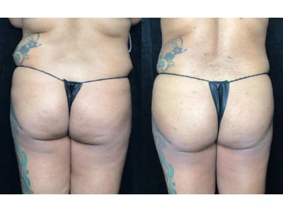 Before and after liposuction, patient case 20021, view 1