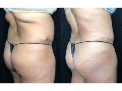 Before and after liposuction, patient case 20021, view 2