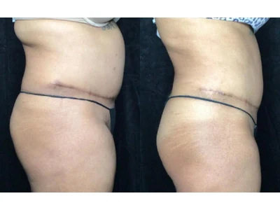 Before and after liposuction, patient case 20021, view 3