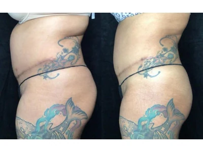 Before and after liposuction, patient case 20021, view 5