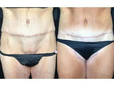 Before and after buttock lift, patient case 20022, view 1