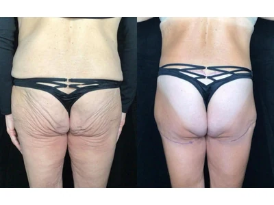 Before and after buttock lift, patient case 20022, view 2