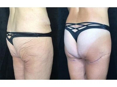 Before and after buttock lift, patient case 20022, view 3