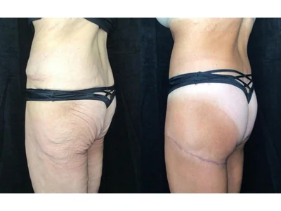 Before and after buttock lift, patient case 20022, view 4