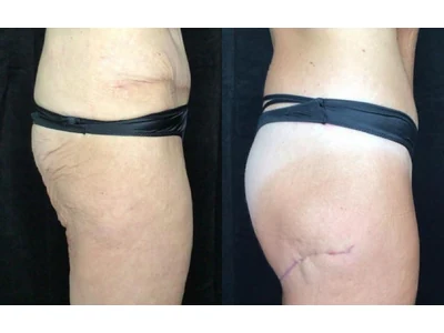 Before and after buttock lift, patient case 20022, view 5
