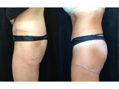 Before and after buttock lift, patient case 20022, view 6