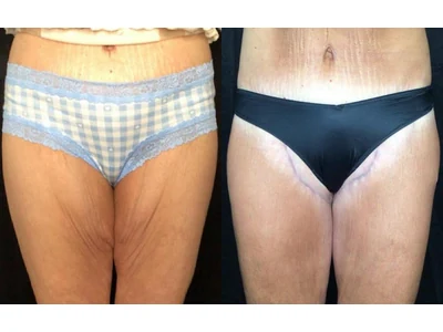 Before and after thigh lift, patient case 20023, view 1