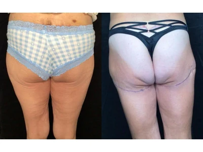 Before and after thigh lift, patient case 20023, view 2