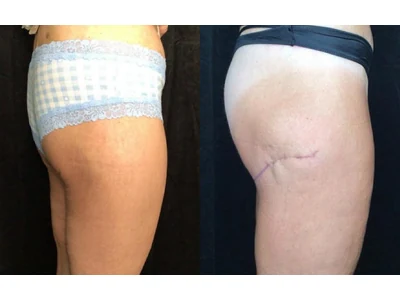 Before and after thigh lift, patient case 20023, view 3