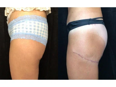Before and after thigh lift, patient case 20023, view 4