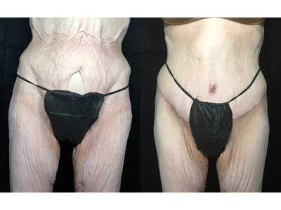 Before and after lower body lift, patient case 20024, view 1