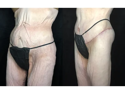 Before and after lower body lift, patient case 20024, view 2
